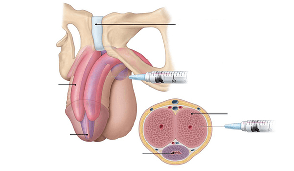Injection of your own adipose tissue to the thickness of the penis