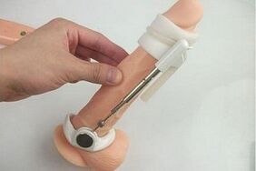use of an extender to enlarge the penis